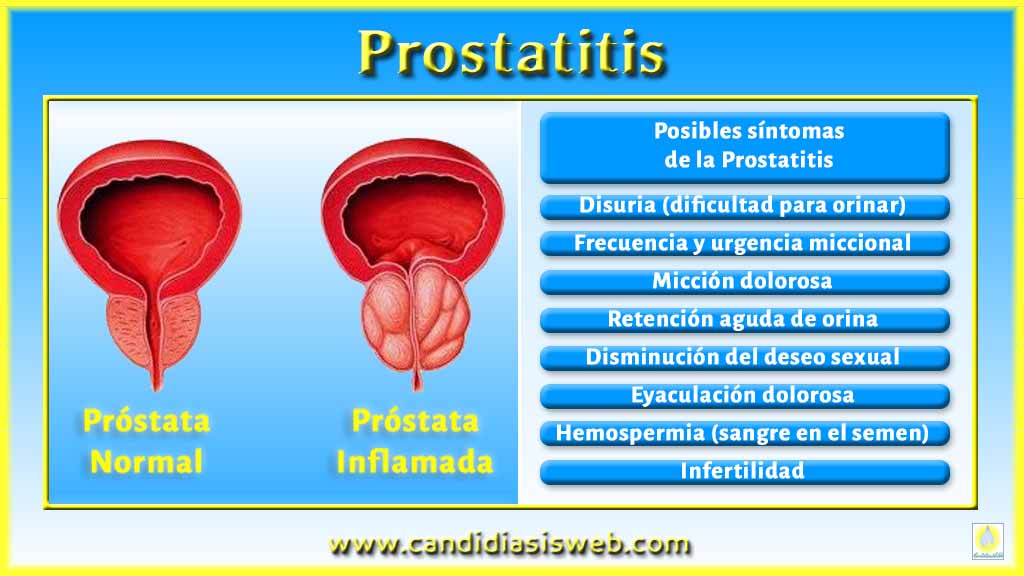 Prostatitis és uretritis)