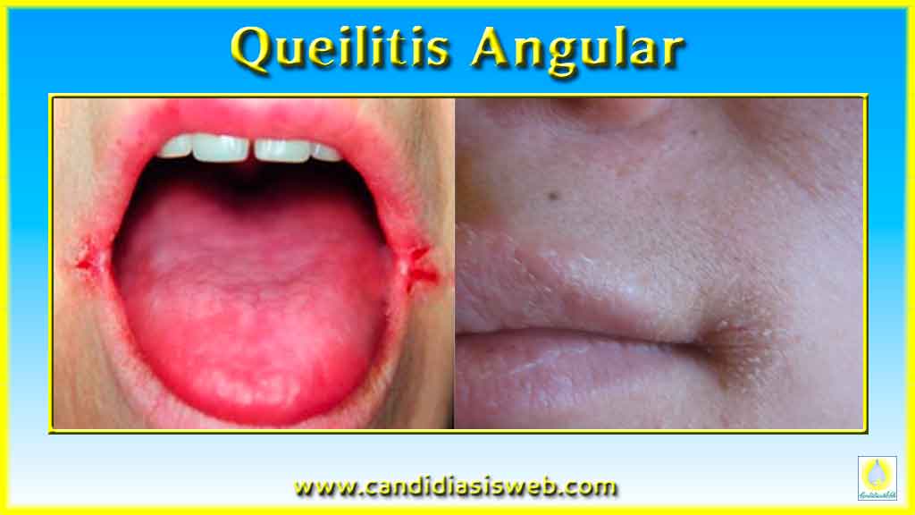 Candidiasis Mucocutaneas Queilitis Angular