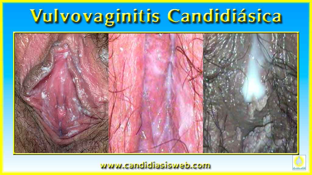 Genital candidiasis deals